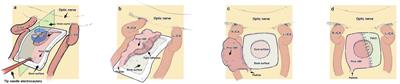 Reducing CSF complications by a recycled Hadad’s flap combined with autologous mucosa in secondary endoscope transsphenoidal surgery